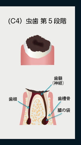 (C4）虫歯第5段階