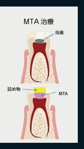 MTA治療