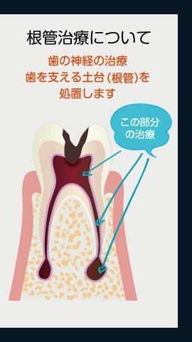 根管治療について