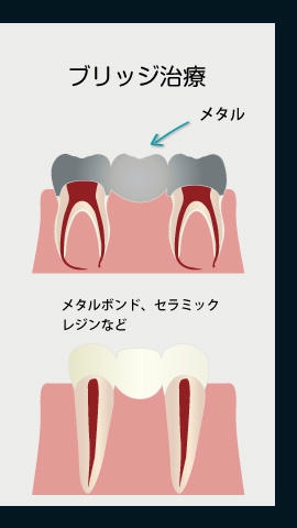 ブリッジ治療