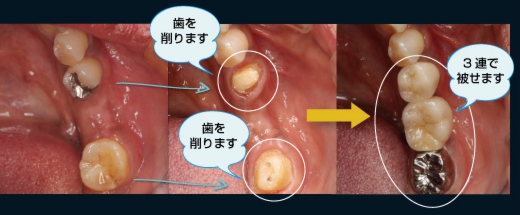 ブリッジ治療