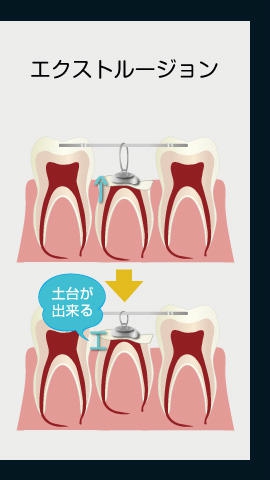 エクストルージョン