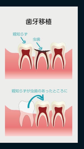 歯牙移植