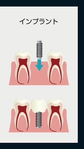 インプラント