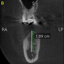 implantCT.jpg