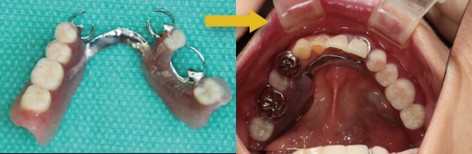 部分床義歯　保険