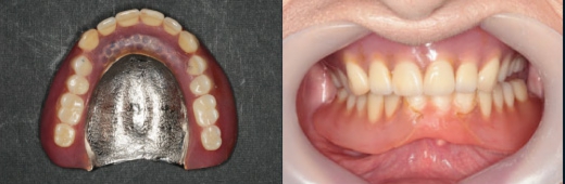 全部床義歯　旧義歯　金属床　自費