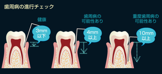 歯周病の進行チェック