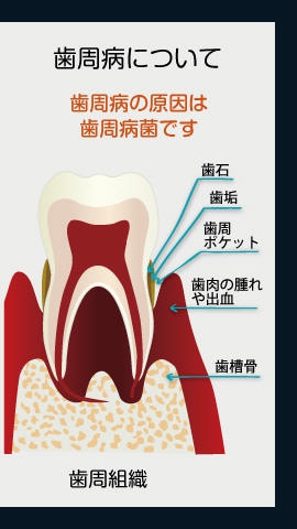 歯周病について