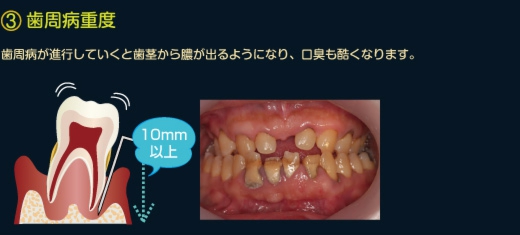 重度歯周病