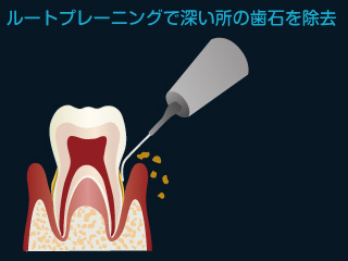 ルートプレーニングで深い所の歯石を除去