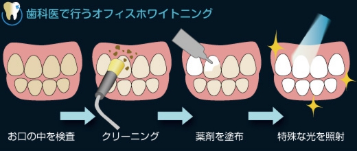 歯科医で行うオフィスホワイトニング