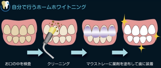 自分で行うホームホワイトニング