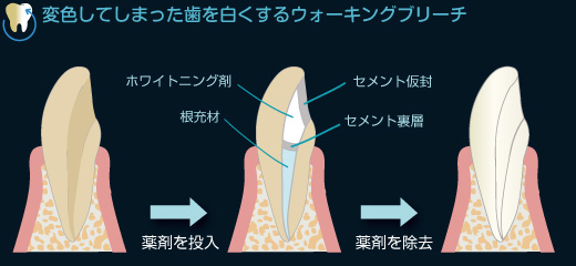 ウォーキングブリーチ