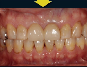 オールセラミッククラウン　治療後