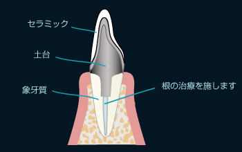 メタルボンド