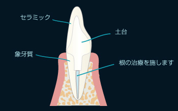 オールセラミッククラウン