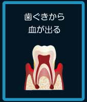 歯茎から血が出る