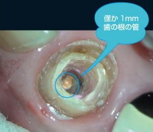 根管治療が終わった後です。