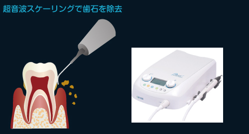 超音波スケーリングで歯石を除去