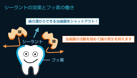 シーラントの効果とフッ素の働き