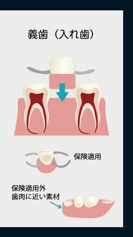 義歯（入れ歯）