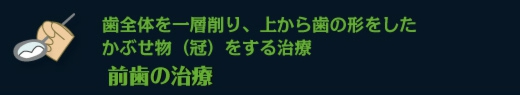 歯全体を一層削り、上から歯の形をした前かぶせ物（冠）をする治療　前歯の治療