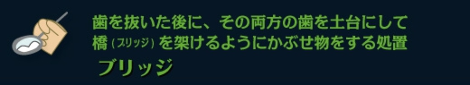 歯を抜いた後に、その両方の歯を土台にして橋（ブリッジ）を架けるようにかぶせ物をする処置