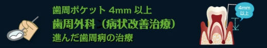 歯周ポケット4mm以上　歯周外科（病状改善治療）　進んだ歯周病の治療